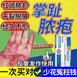 掌趾脓疱病掌跖脓包角化病症QK专用手脚脓包角化病脱皮干裂