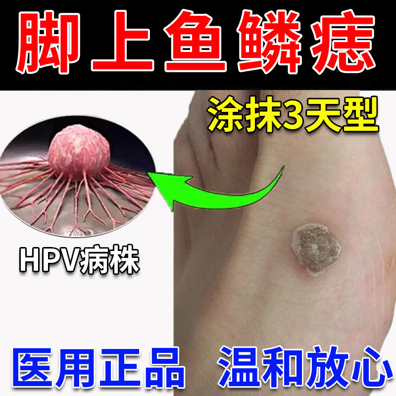 脚上鱼鳞痣药膏猴子去除药膏去庞瘊猴子肉粒疙瘩一抹无忧js