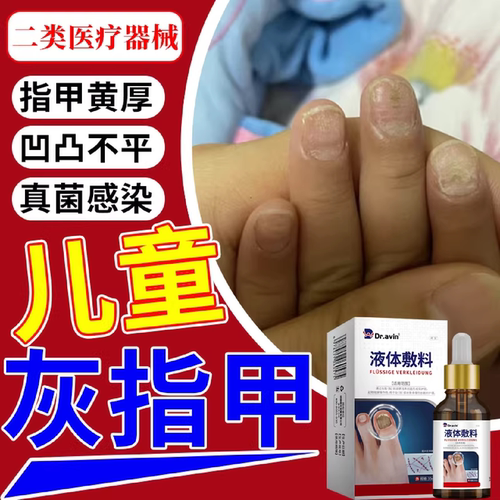 儿童手指灰指甲真菌感染指甲增厚