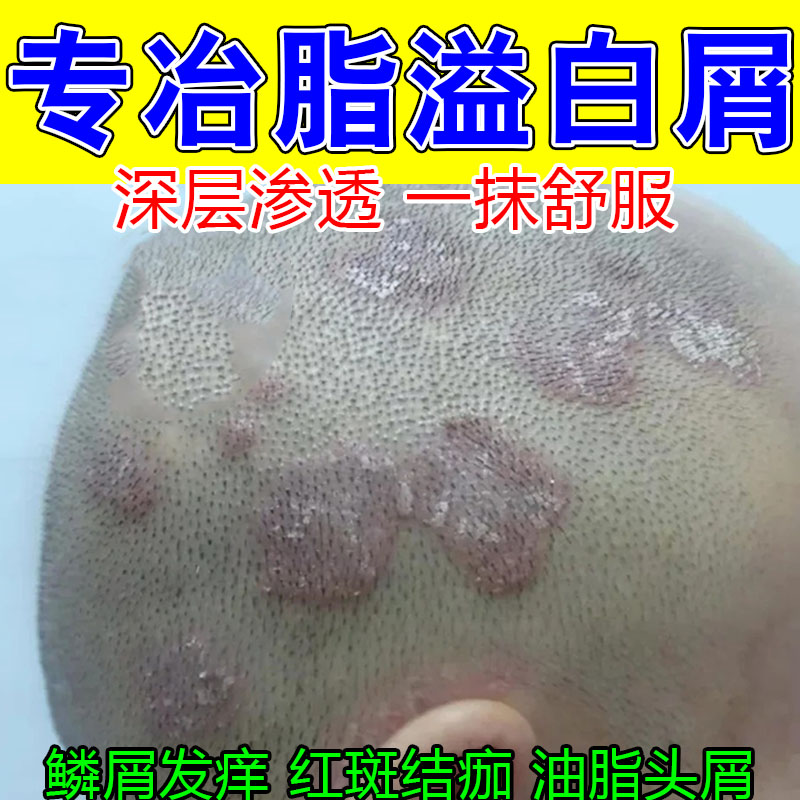 头部白屑结痂干痒红肿结痂起白屑起皮粗糙不适头皮植物萃取修护膏