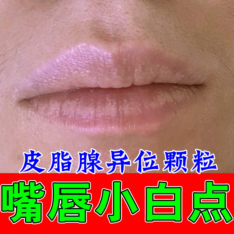 皮脂腺异位嘴唇白色颗粒嘴唇脂肪小颗粒增生起泡干裂起皮修护乳膏