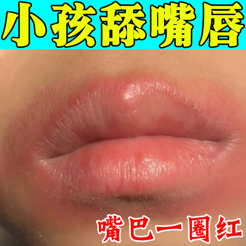 小孩舔嘴唇羊胡子疮起泡刺痛小孩舔嘴唇周炎上火烂嘴角脱皮专用膏