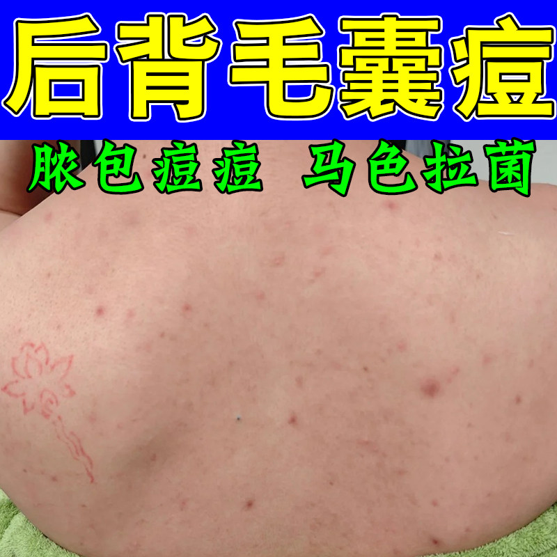 专冶后背疙瘩痘毛囊长痘脓包疙瘩毛囊发痒堵塞肿痒草本修护膏乳