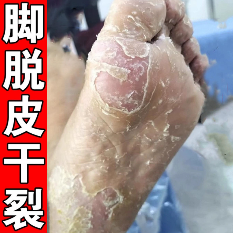 脚脱皮脚底板掉皮起硬皮干裂去死皮手足脱皮皲裂专用膏真菌角化型