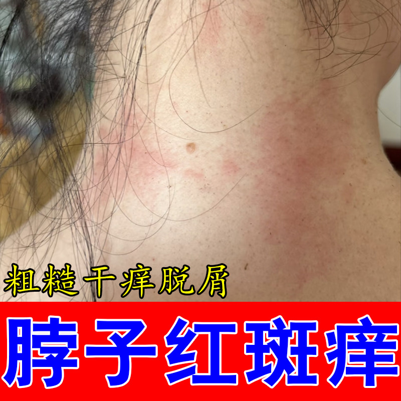 夏季天热脖子皮肤痒颈部过敏红肿痒起红疙瘩痒粗糙红疙瘩乳膏