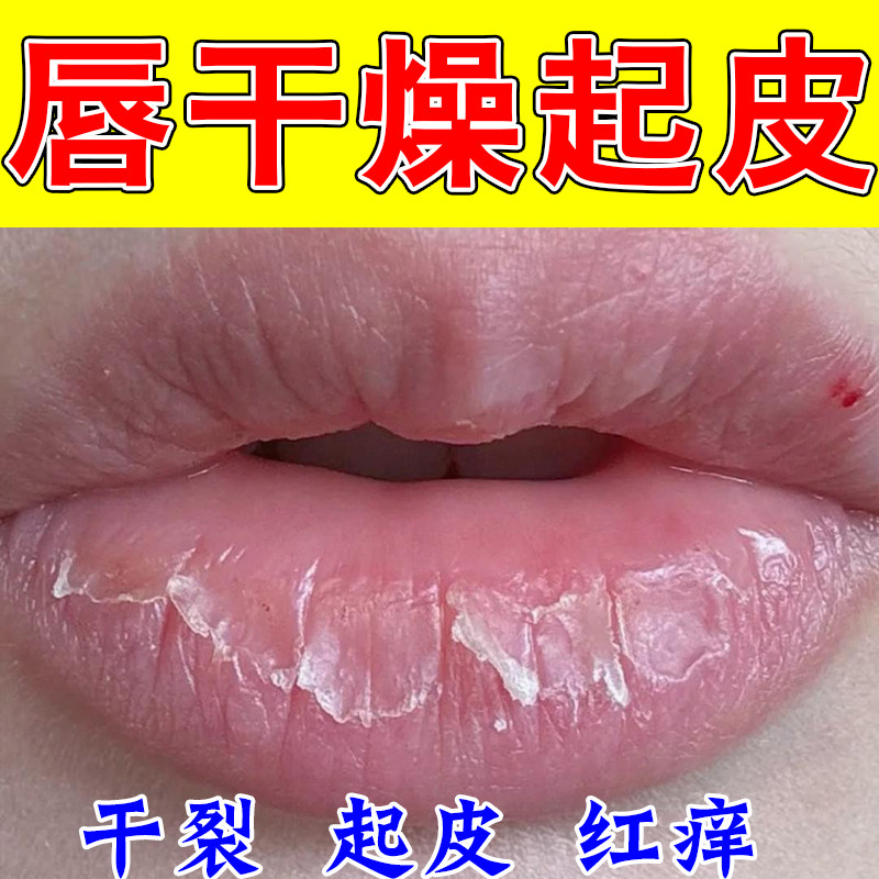 嘴唇干躁起皮皲裂褪皮泛白皲裂唇皮掀起纹路明显柔润补水唇膏