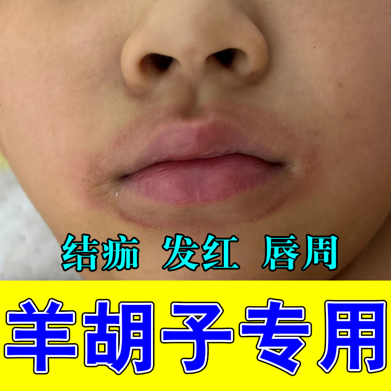 儿童嘴巴周边泛红结痂干疼舔唇起皮干裂不适草本舒缓修护膏