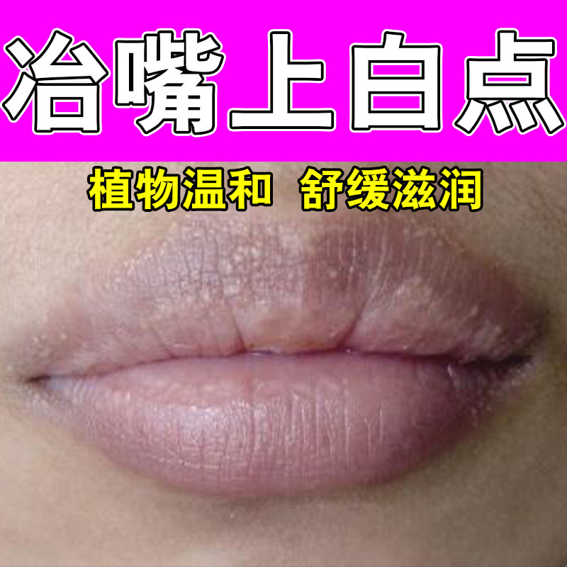 皮脂腺异位嘴唇干裂起泡唇部长脂肪粒小白点嘴巴暗沉长白斑保湿膏