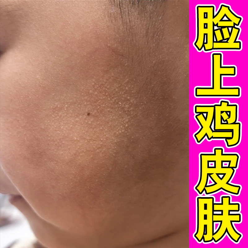 去脸上起小疙瘩脸颊两侧小颗粒颈部毛囊红斑闭口粉刺脸颊两边鸡皮