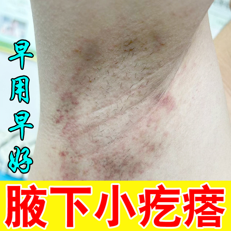 腋下发红发痒红肿硬块腋下长红斑疙瘩皮肤红肿疼痛出汗发臭专用膏