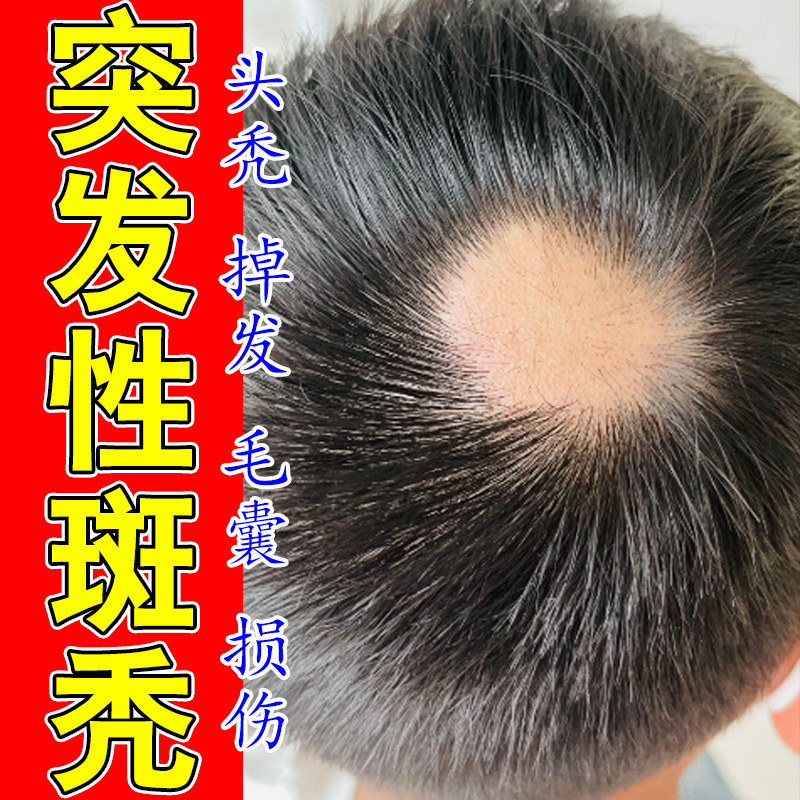头顶大面积掉发后脑勺秃顶头发稀少深层修护发根草本防脱发喷剂