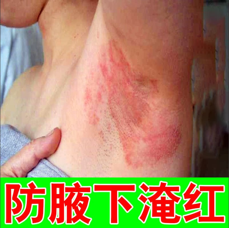 腋下淹红腋窝防淹红肿刺痛多汗异味胳肢窝红腋窝草本修护软膏