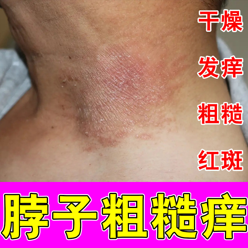 脖子后面痒脖圈斑红痒刺挠颈部上起红疙瘩过敏神经皮肤粗糙保湿膏