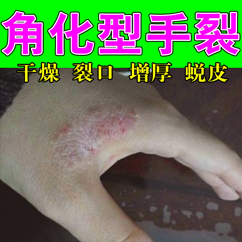 手背红斑发痒起皮屑红肿手上红斑凸起硬块粗糙起皮真菌舒缓草本膏