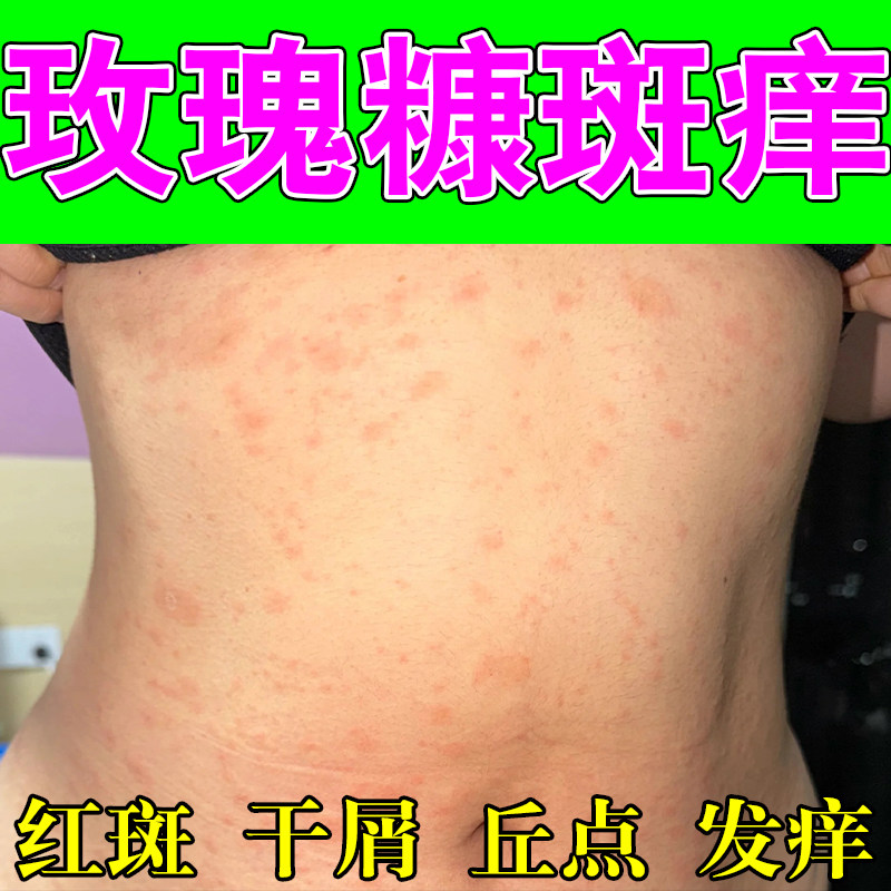 身上玫瑰红斑粗糙干燥皮肤痒红点红斑过敏红斑干痒修护保湿膏