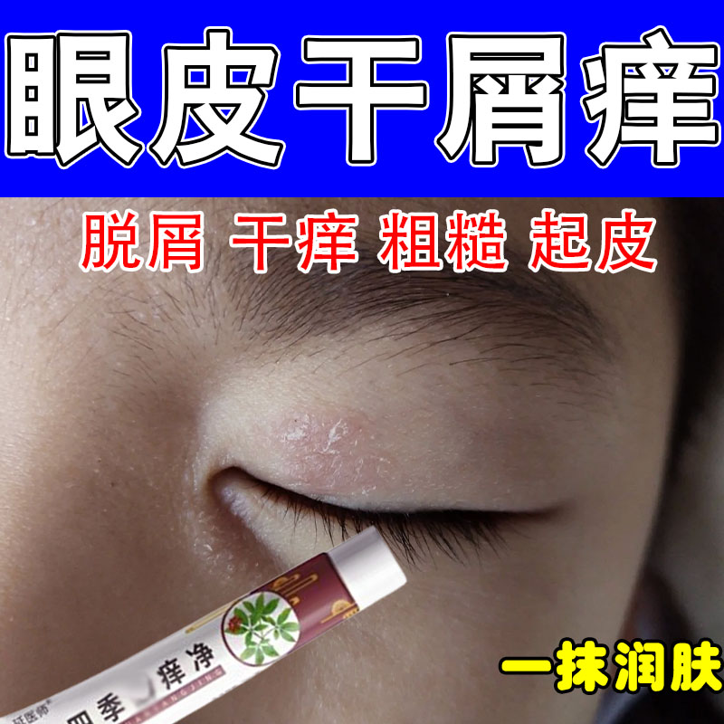 眼皮神经性干燥粗糙起皮红肿痒眼周起皮过敏眼角发痒草本修护软膏