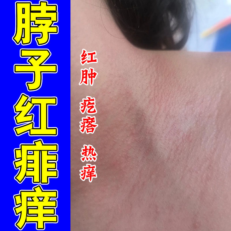 痱子天热身上红疙瘩大片发痒小疙瘩红点痒修护植物喷剂
