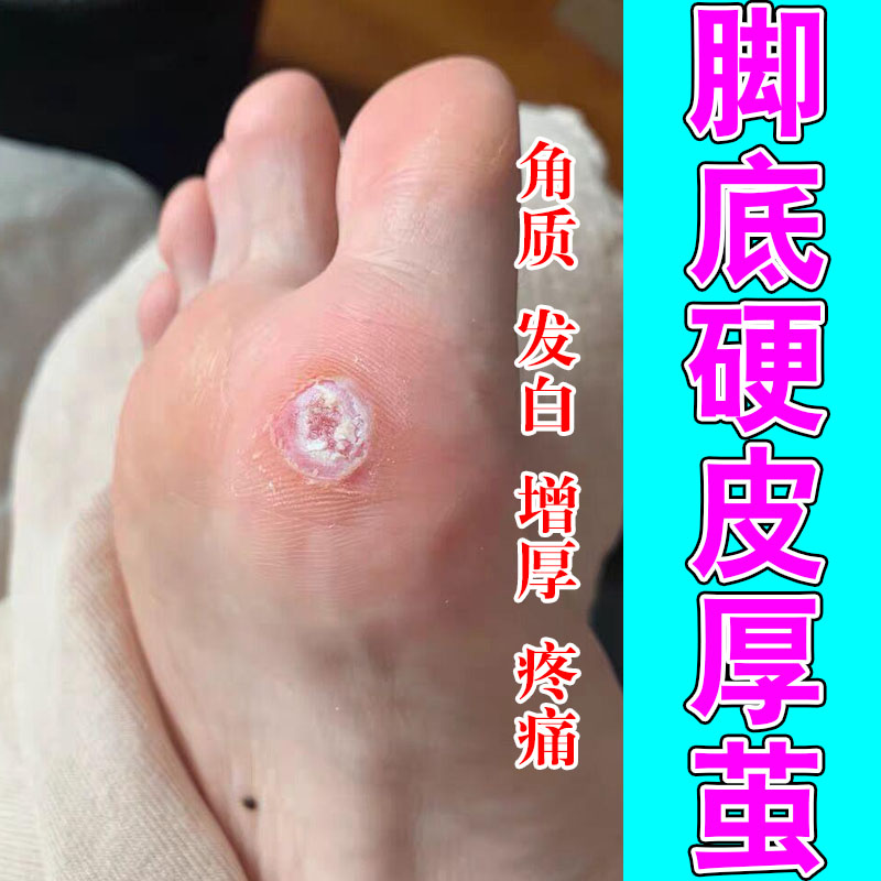 足部茧质脚底脚垫脚后跟厚皮脚趾关节角质增厚脚部舒缓养护贴