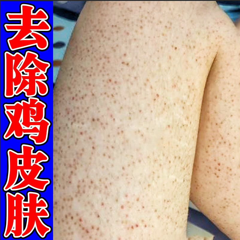 鸡皮肤疙瘩毛囊角化软膏身上腿部胳膊上小疙瘩黑点鱼鳞蛇皮身体乳