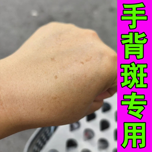 手上老年斑脸上手背黑色素沉淀手部长斑手背晒黑斑黄褐斑雀斑专用