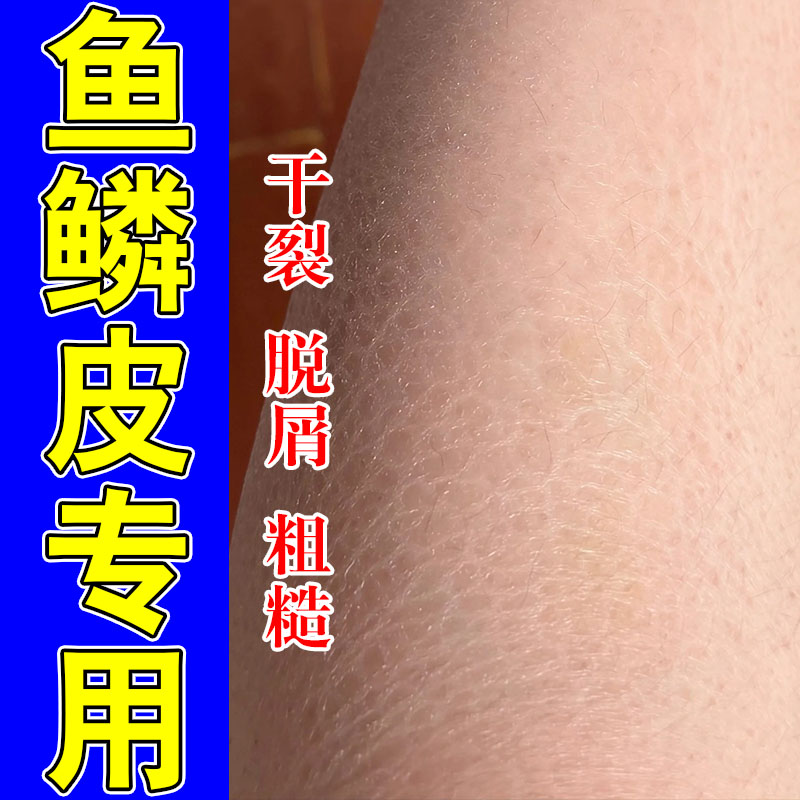 皮肤干燥起皮身体冬天腿上掉皮屑小腿发痒鱼鳞皮保湿滋润甘油