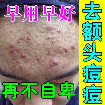 去额头痘痘闭口粉刺毛囊炎痘印脸上青春痘小疙瘩修复痘坑祛痘神器