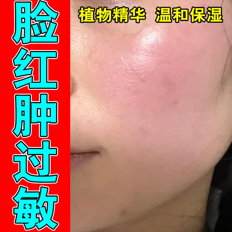 脸部肌肤发红干痒红肿刺痛脱屑敏感灼热植物萃取保湿膏