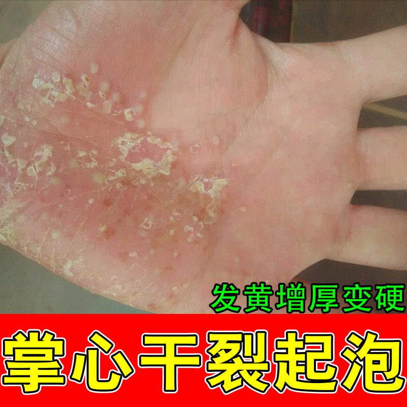 掌跖手足手手干燥粗糙起皮干裂脱皮泛红角质增厚外用护肤乳膏