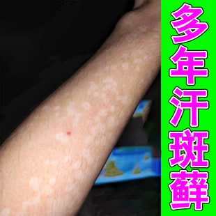 身上汗斑净汗斑花斑专用软膏全身长汉斑褐斑白斑点点促黑阻白膏