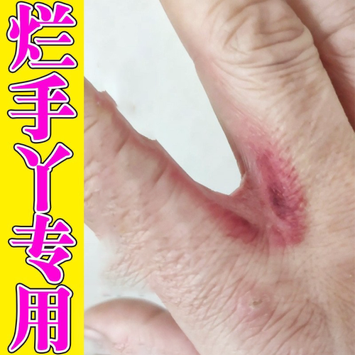 手指缝溃烂痒膏烂手丫指间糜烂长水泡发红脱皮开裂脱皮掉屑