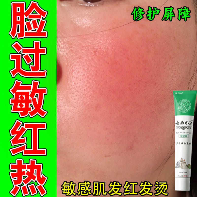 脸红脸过敏红脸敏感肌泛红红血丝遇热发红发热植物舒缓膏
