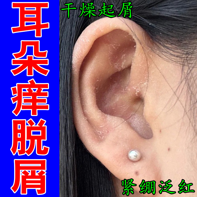 专冶耳内干燥发痒反复起皮结痂外耳道干屑真菌性耳痒结痂萃取膏