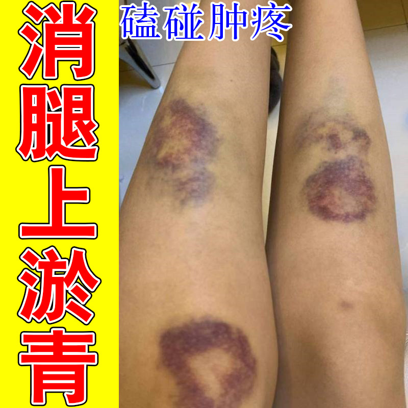 冶腿上淤青膝盖腿磕碰撞伤乌黑发紫红肿疼痛散淤活血化瘀专用膏
