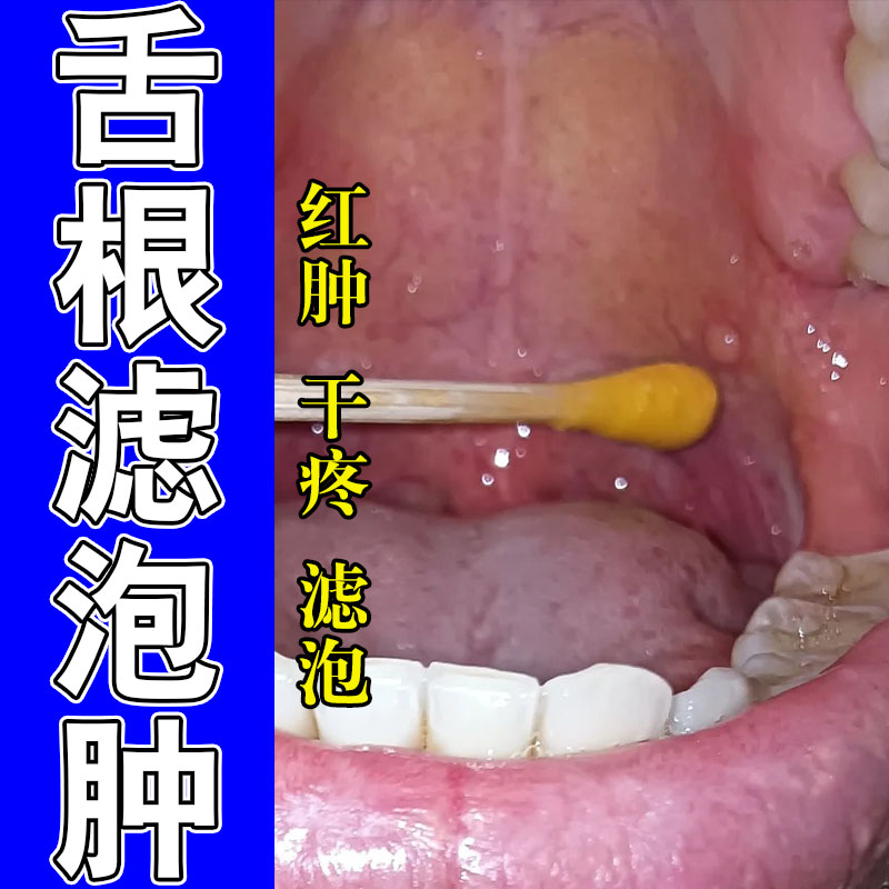 草本咽喉咽喉壁舌部滤泡增生喉咙发烫异物感滋润舒缓喷剂