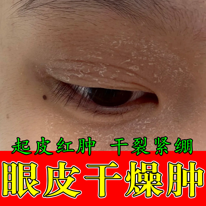 眼皮神经性干燥粗糙起皮红肿痒眼周起皮过敏眼角发痒草本修护软膏