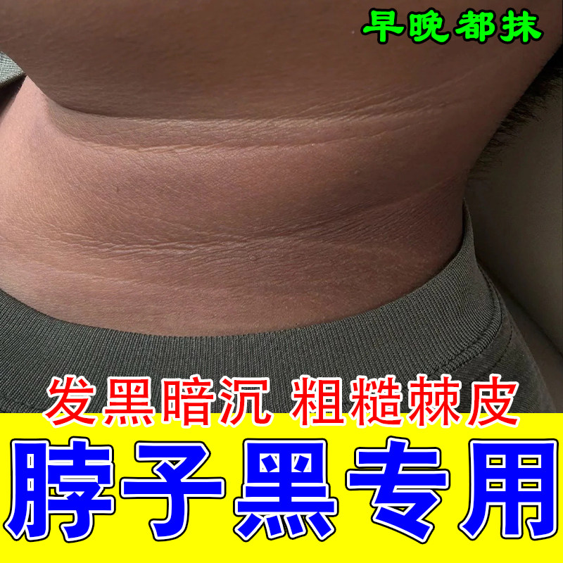 脖子黑外用身上黑印沉淀脖子黑色素沉淀小孩儿童脖颈暗沉黑色素膏