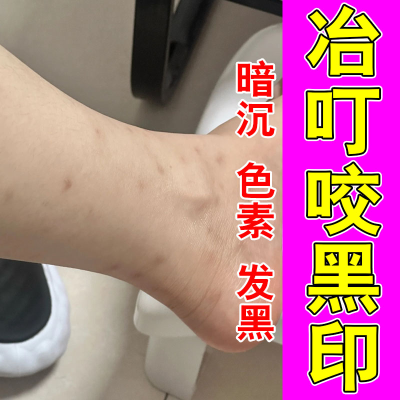 淡化蚊虫叮咬黑印改善皮肤抓挠深色明显黑斑修护按摩膏