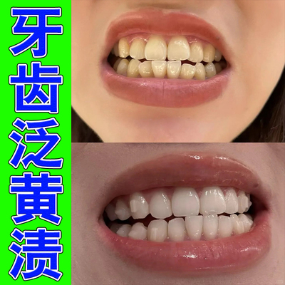牙齿黑斑牙菌斑黑线黑渍牙窝沟清洁蛀牙菌斑牙缝发黑