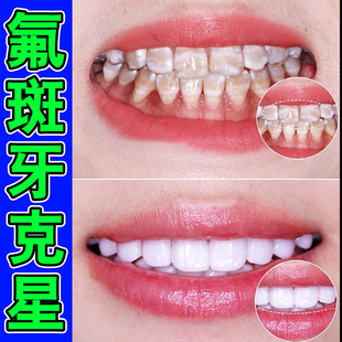牙斑净牙缝清理牙根黑斑黄牙黑牙垢烟渍茶渍洁白牙齿