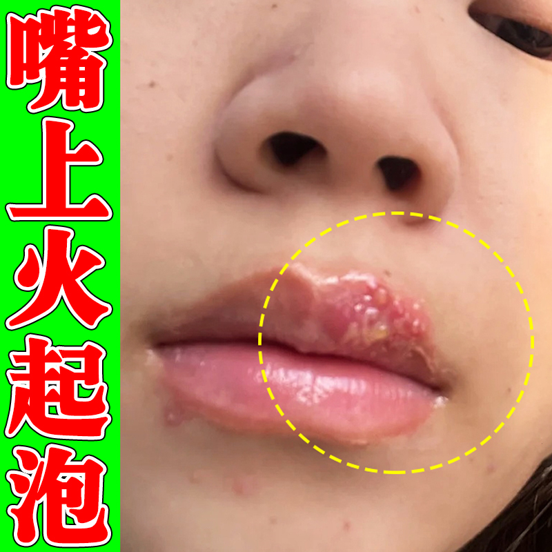 嘴唇上火起泡烂嘴角口角炎专药用膏干裂脱皮红肿痒专用修复润唇膏