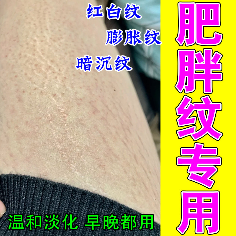 肥胖纹去修复膏生长纹淡化大腿学生腰腹部淡化纹路去肥胖纹专用