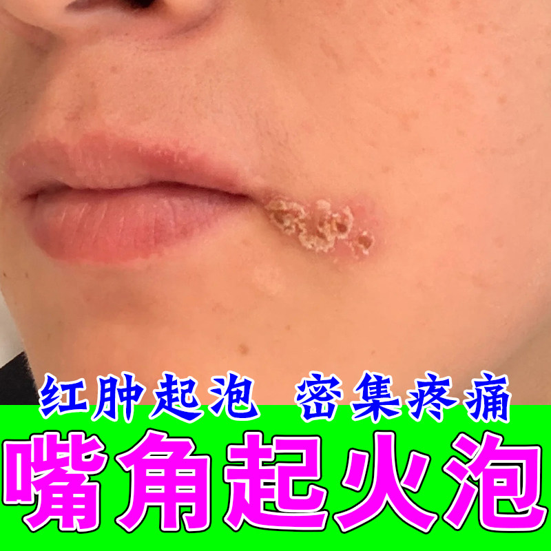 唇上火唇膏润嘴唇干裂脱皮保湿滋润去死皮医用口角上火水泡性膏乳