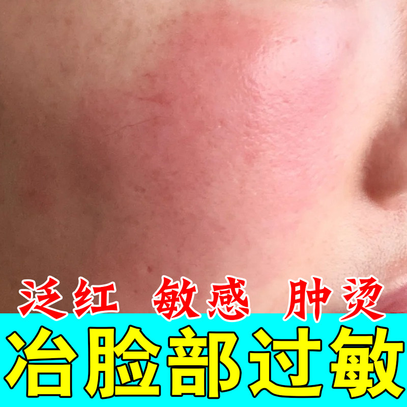 冶敏感脸上干燥起皮过敏发红脸部泛红敏感刺痛红肿痒过季节修护膏