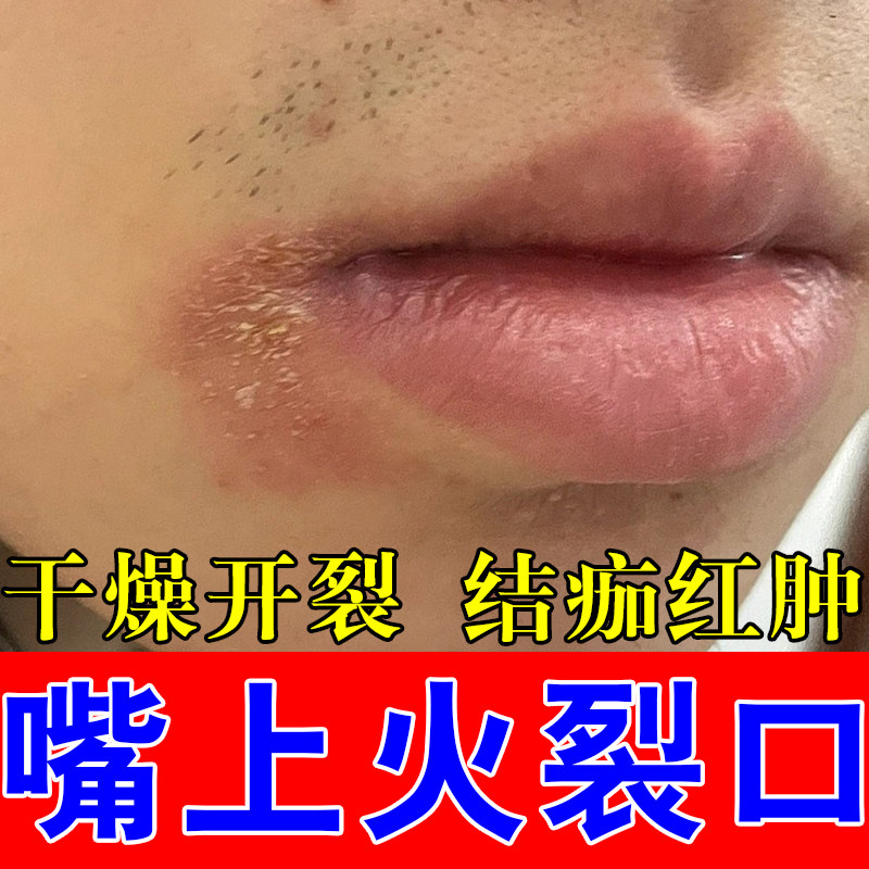 口角干裂疼嘴角上火肿疼冶上火开裂真菌起皮粗糙脱皮专用草本乳膏