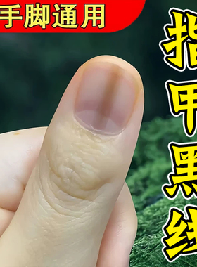 指甲长黑线甲母痣黑指甲专用修复液手脚指甲真菌感染黑色竖纹灰甲