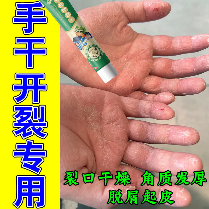 手掌干裂粗糙起白屑痒起死皮手粗糙干燥痒防开裂专用修护保湿软膏
