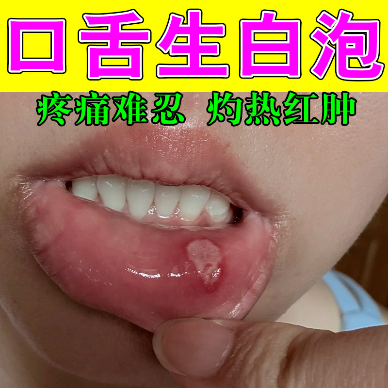 专攻嘴巴上火摩擦红肿疼白斑厚起泡上火刺痛口腔黏膜碰疼植物喷剂