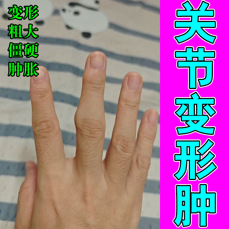手指肿大粗大老人手骨节鼓包僵硬弯曲困难胀痛专用软膏修护