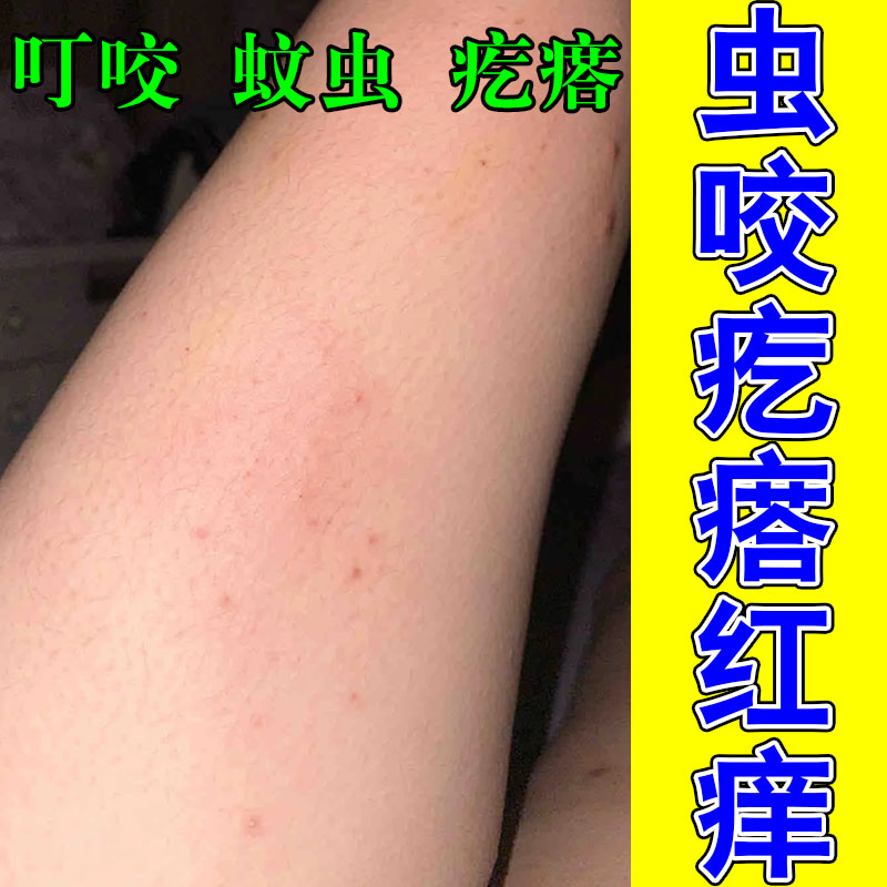后背疙瘩发痒螨虫舒缓频繁痒皮肤抓挠结痂肿痛修护植物乳膏
