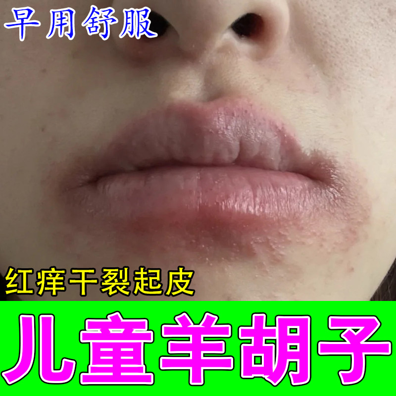 小孩嘴巴一圈羊胡子泛红结痂干疼舔嘴起皮不适肿疼润肤保湿软霜
